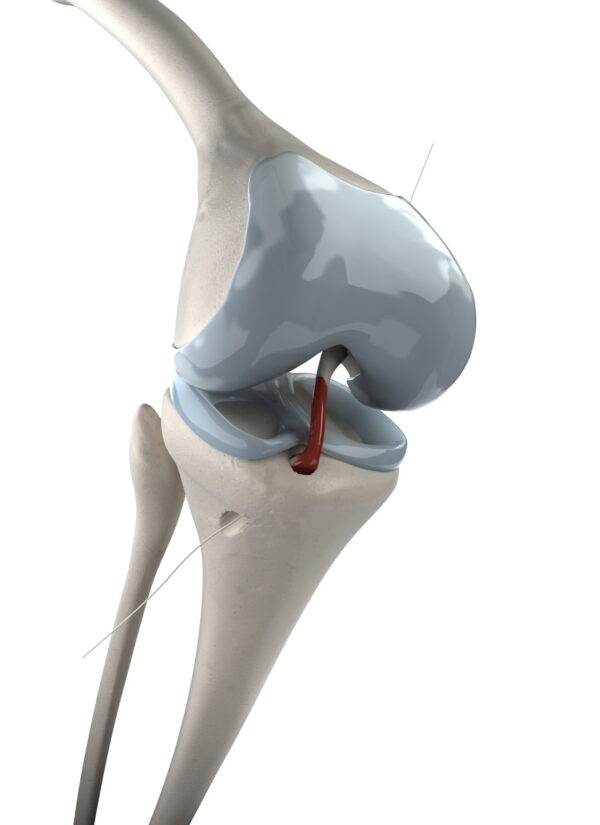 anterior-cruciate-ligament-acl-injury