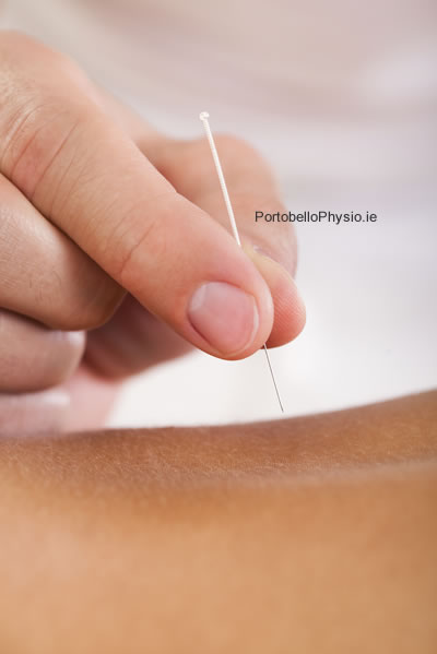 Dry Needling