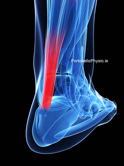 Achilles Tendinopathy Physiotherapy
